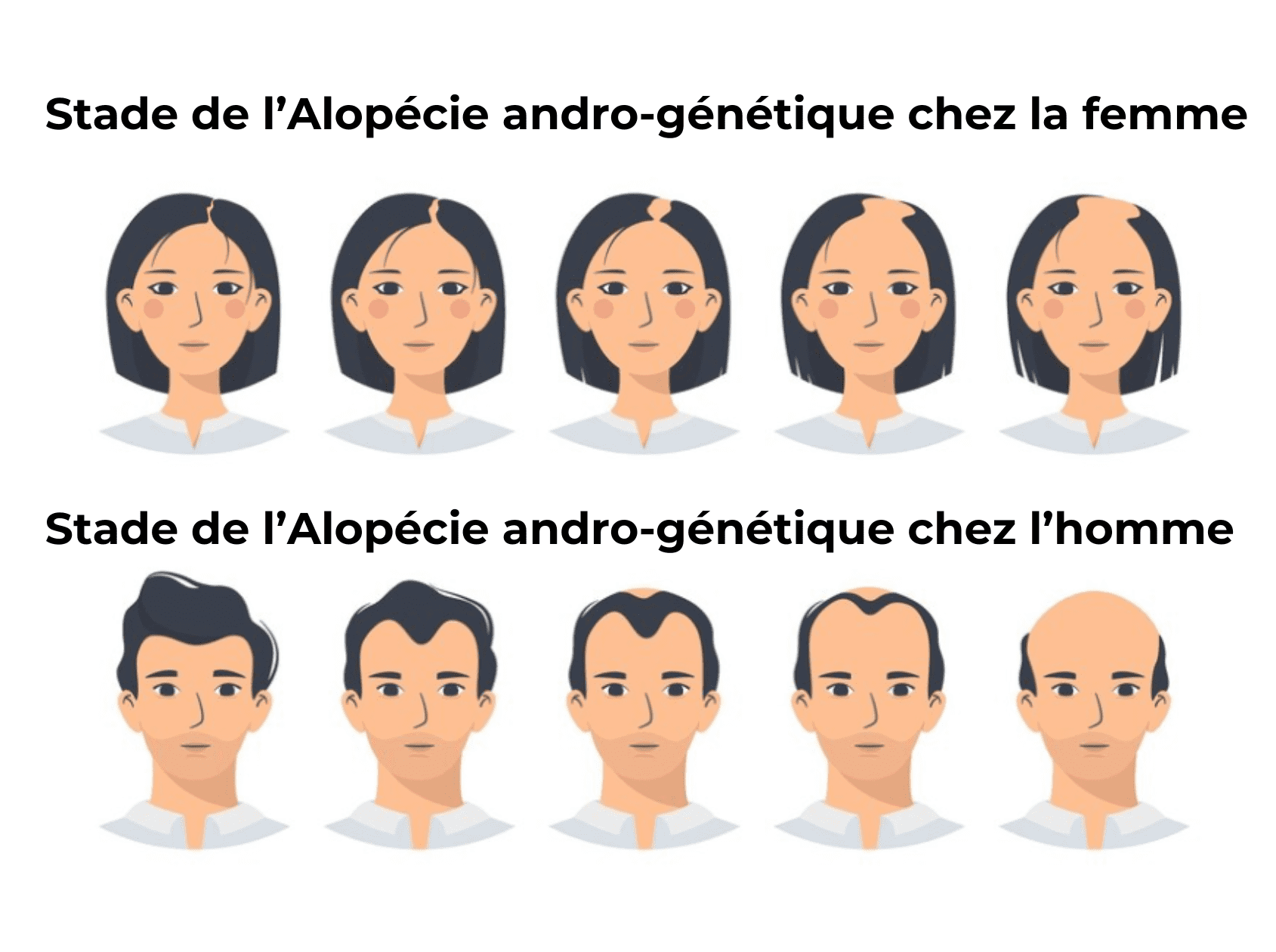 Differents types de chute de cheveux . stade de l'alopecie andro genetique chez l'homme et la femme