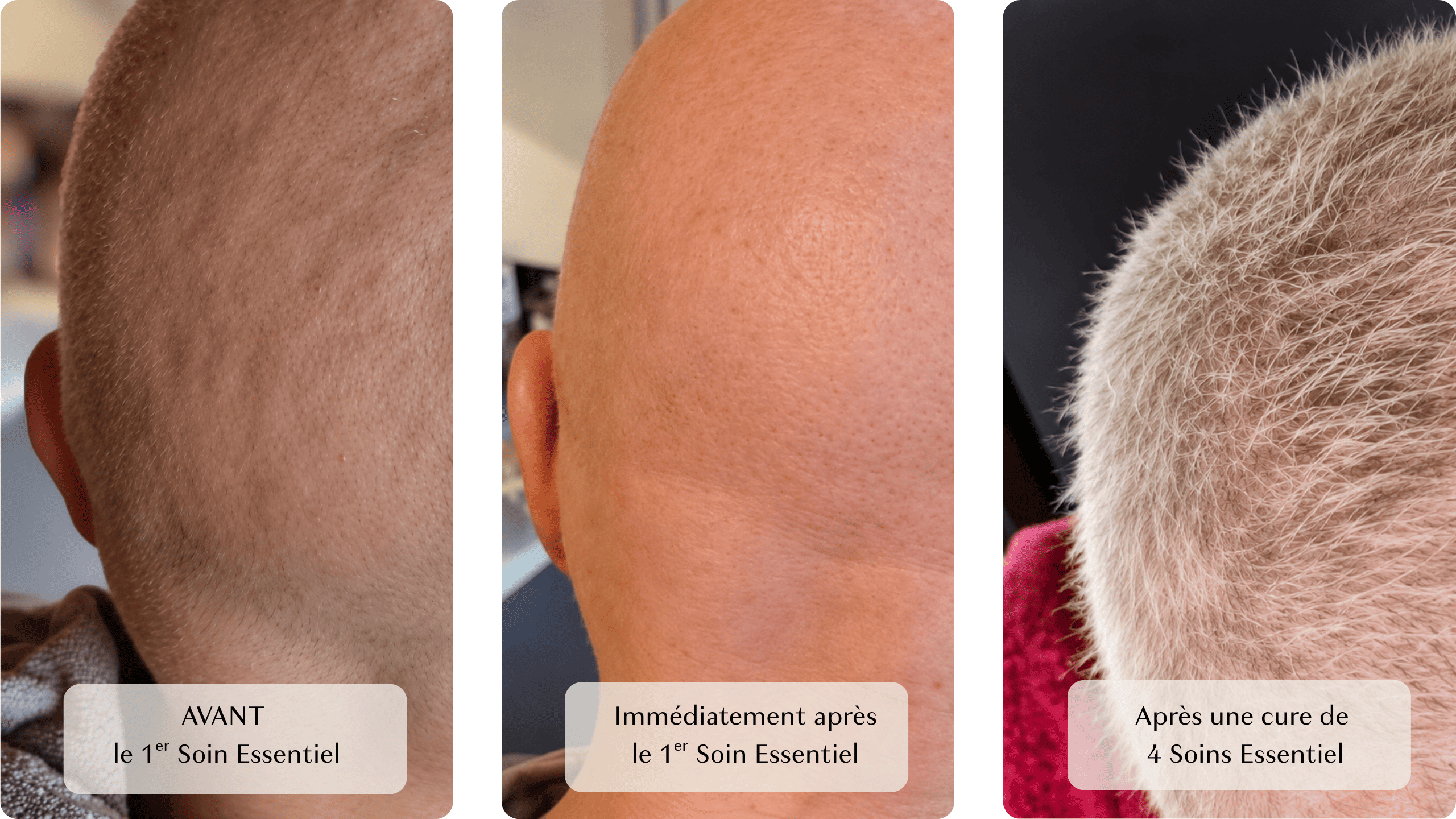 résultat du rituel essentiel après 4 soins sur une personnes sans cheveux